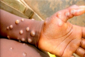 OMS declara al virus del mpox como emergencia